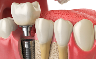 Implantes dentales