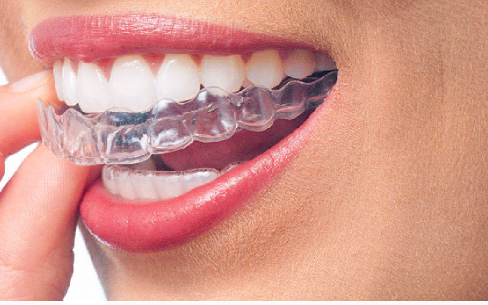 Invisalign